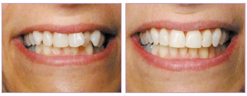 Ortodonzia Invisalign