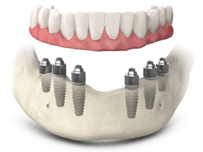Protesi dentali All on 6