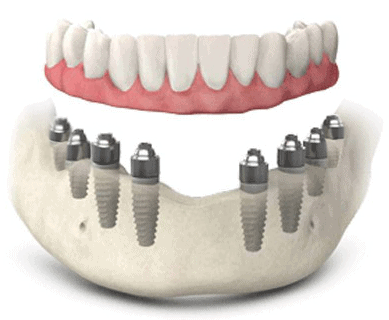 Protesi dentali All on 8