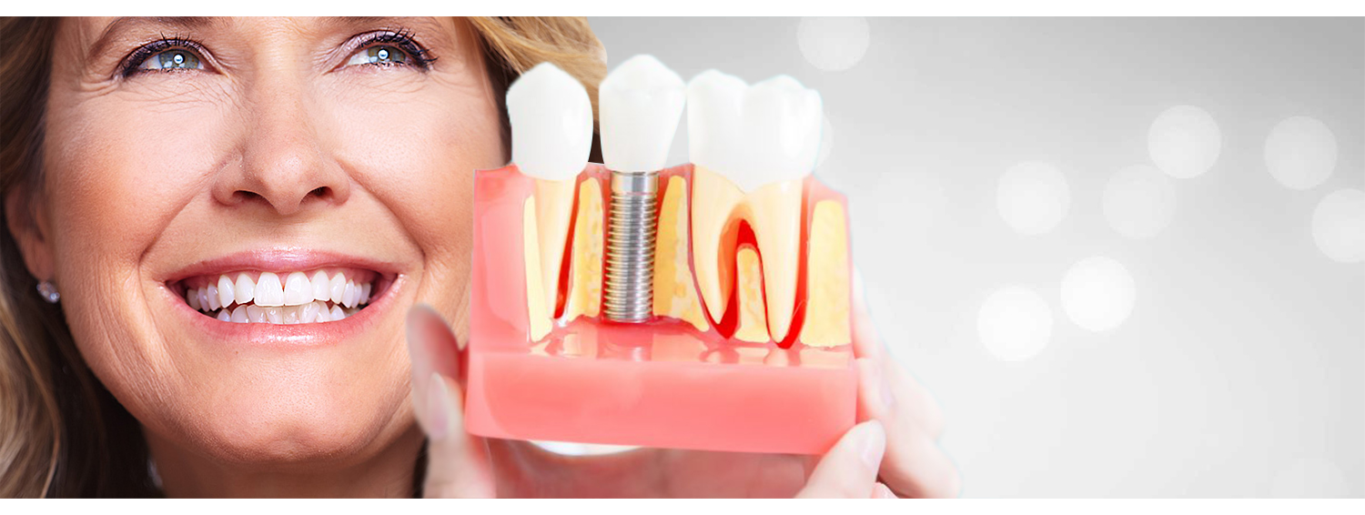 Implants dentaires Avantages de l