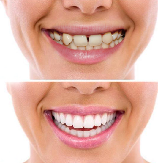 corone in zirconio