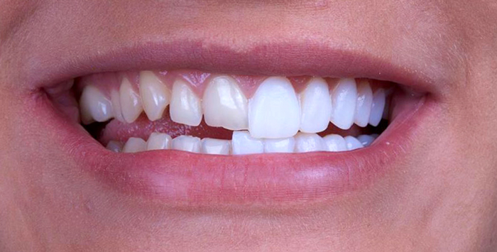 faccette dentali estetiche