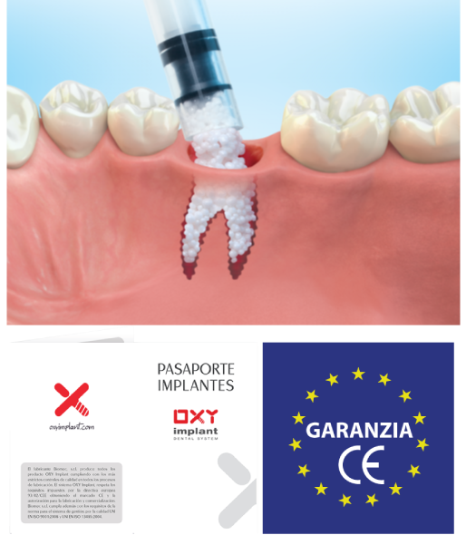 impianti dentali senza osso