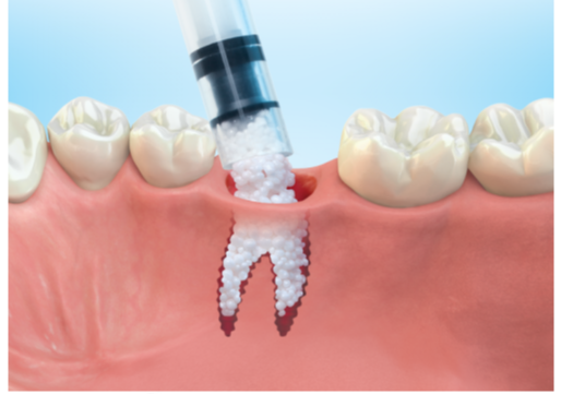 implants dentaires sans os