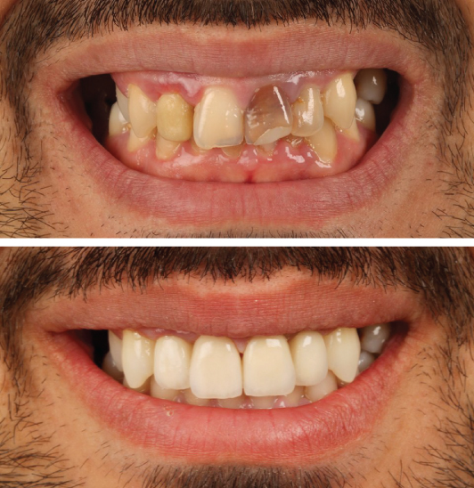 faccette estetiche