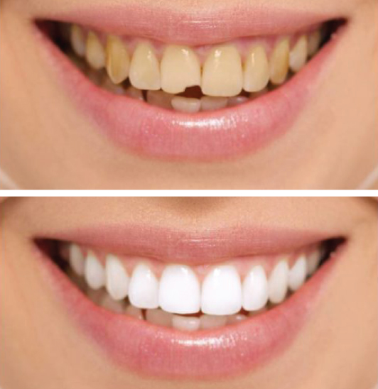 faccette dentali estetiche
