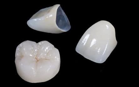 Corone Dentali in Metallo