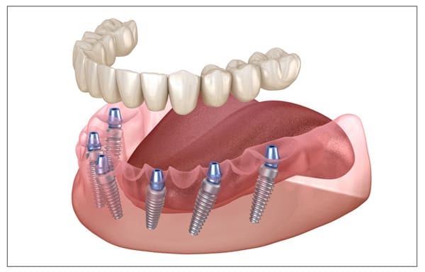 protesi-dentali-albania-all-on-6