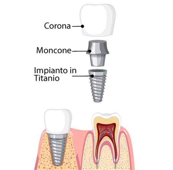 impianto-dentale