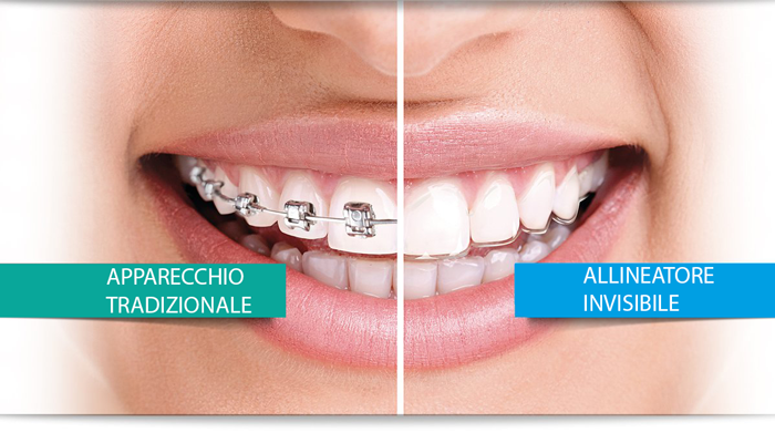 Come Avere Denti Perfetti “Senza Apparecchio” - Gremi Clinic