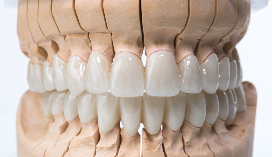 Prothèse dentaire fixe sur dents naturelles - Gremi Clinic