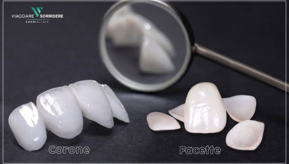 Meglio corone in zirconio o faccette dentali?
