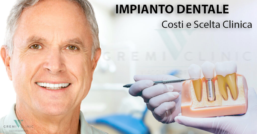 Impianto Dentale Guida ai Costi e alla Scelta della Giusta Clinica