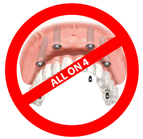 NO_all-on-4